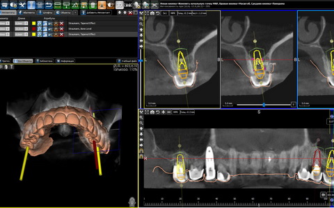 3Д Навигационная стоматология