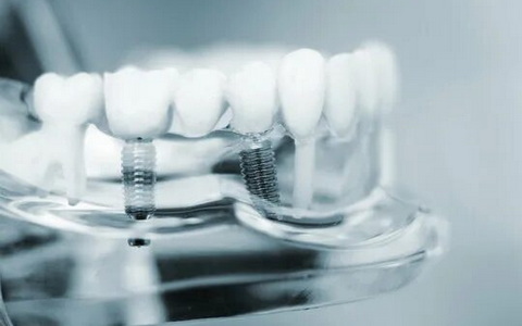 Имплантация зубов